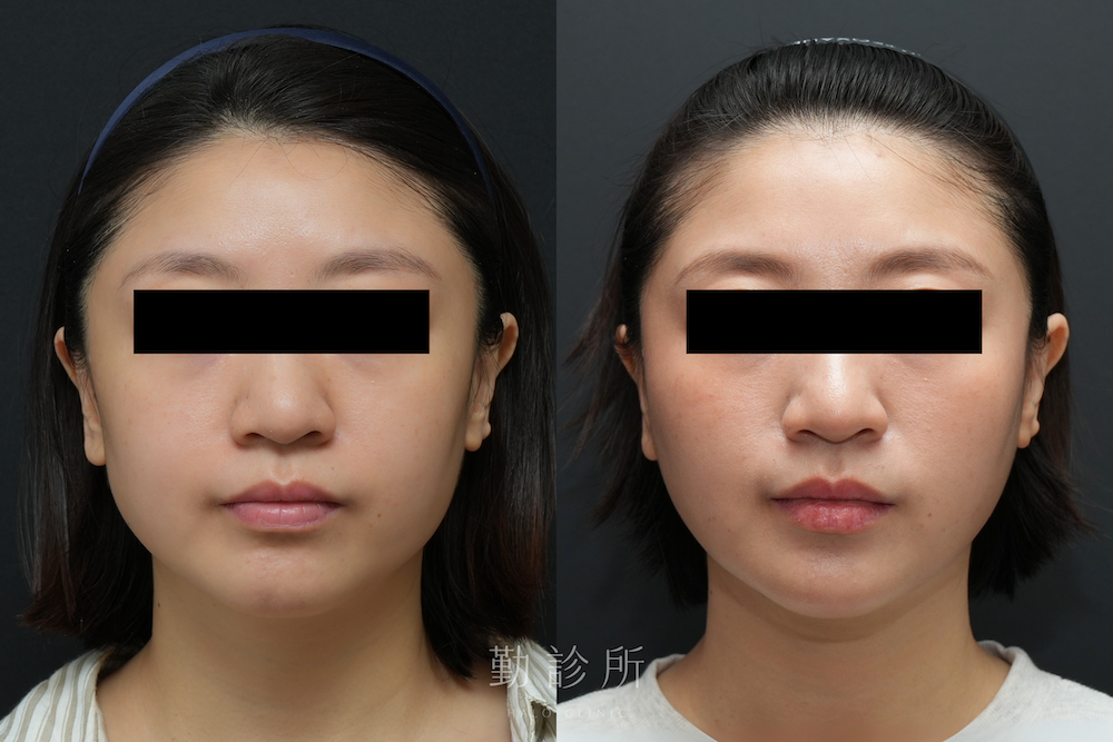 勤診所|跨層次迴繞拉提案例:中下臉拉提 改善嘴邊肉、 V 臉 正面