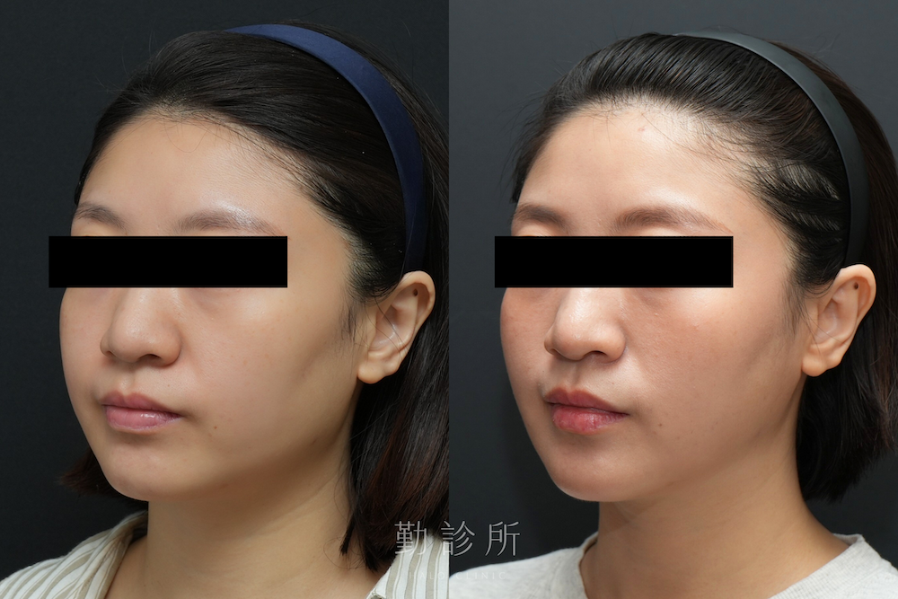 勤診所|跨層次迴繞拉提案例:中下臉拉提 改善嘴邊肉、 V 臉 左臉