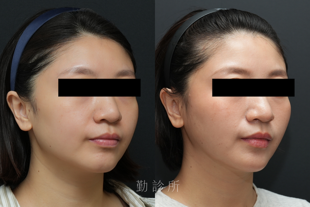 勤診所|跨層次迴繞拉提案例:中下臉拉提 改善嘴邊肉、 V 臉 右臉
