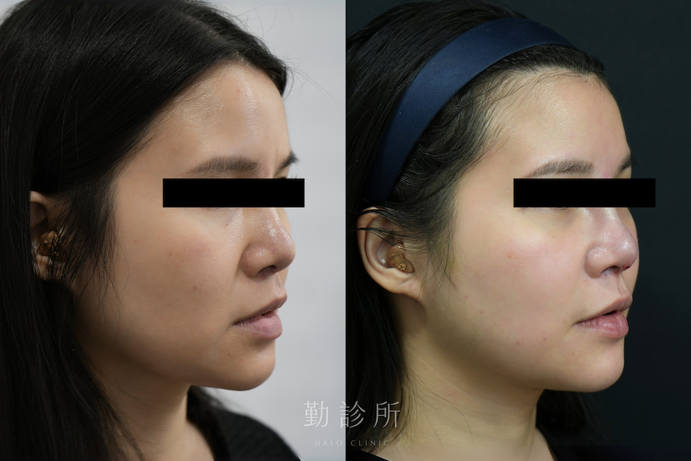 勤診所|跨層次迴繞拉提案例:半臉拉提 改善大小臉 + 玻尿酸法令紋 + 鼻雕 右臉