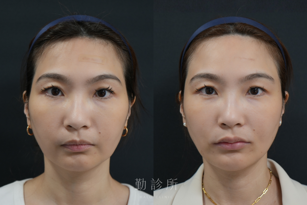勤診所|跨層次迴繞拉提案例:中下臉拉提 改善嘴邊肉、清晰輪廓線 正面