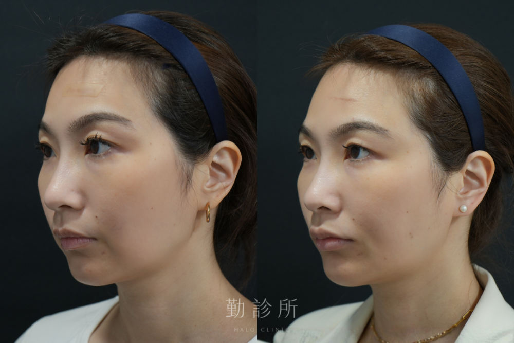勤診所|跨層次迴繞拉提案例:中下臉拉提 改善嘴邊肉、清晰輪廓線 左臉