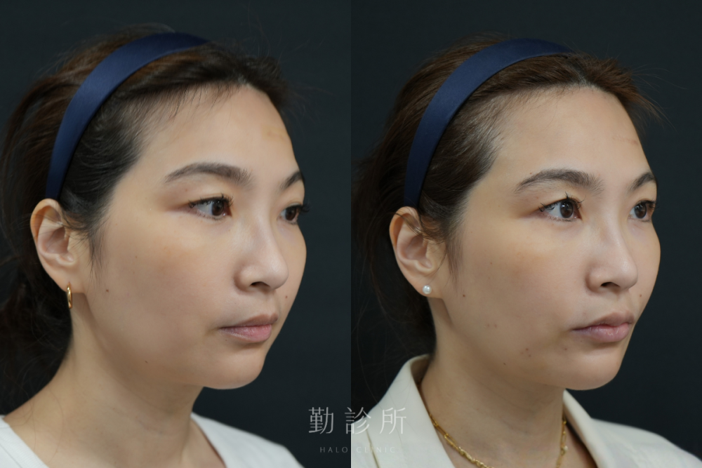 勤診所|跨層次迴繞拉提案例:中下臉拉提 改善嘴邊肉、清晰輪廓線 右臉
