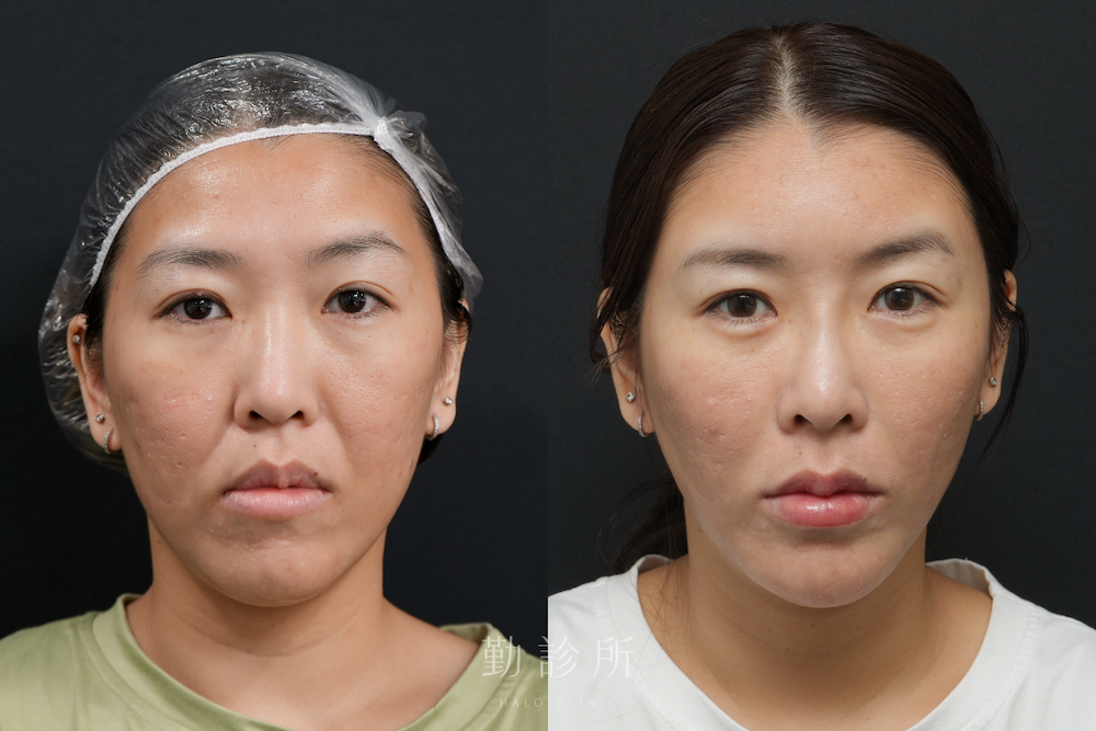 勤診所|跨層次迴繞拉提案例:中下臉拉提 抬升頻果肌、改善法令紋+玻尿酸全臉注射規劃 正面