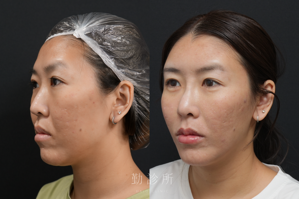 勤診所|跨層次迴繞拉提案例:中下臉拉提 抬升頻果肌、改善法令紋+玻尿酸全臉注射規劃 左臉