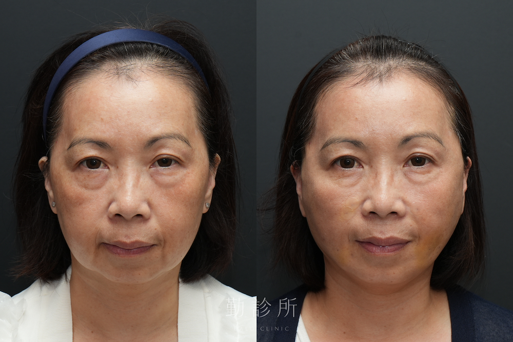 勤診所|跨層次迴繞拉提案例:全臉組織抬升 正面