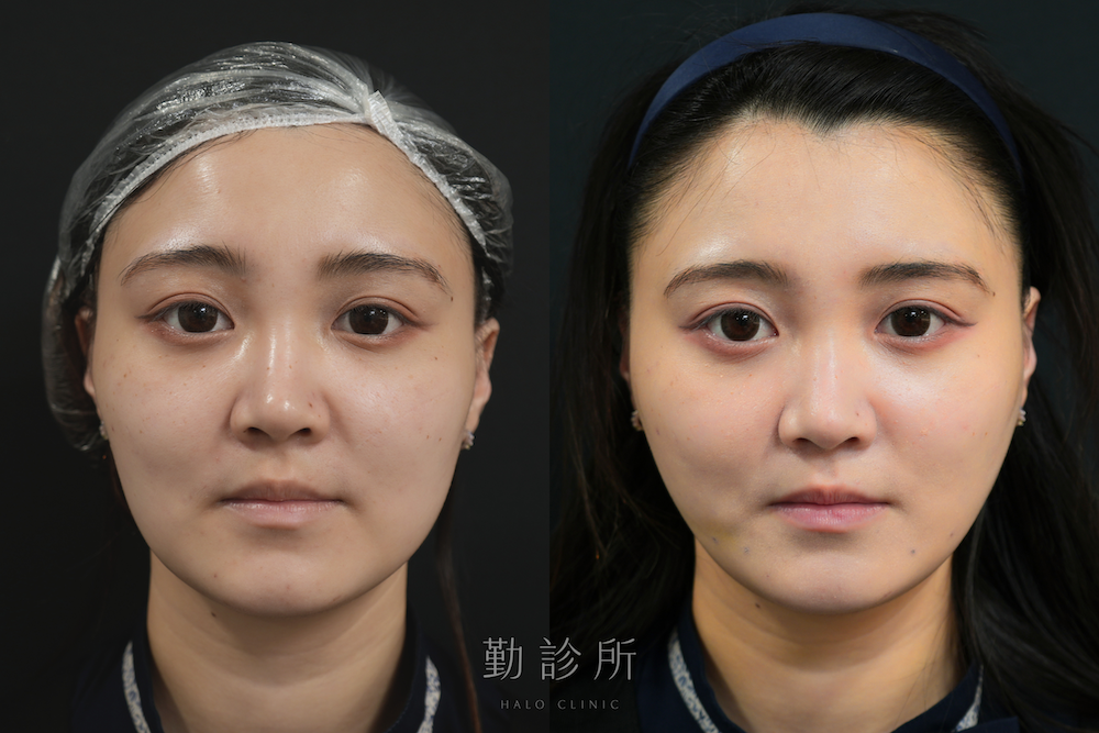 勤診所|跨層次迴繞拉提案例:中下臉拉提 抬升蘋果肌改善法令、V臉 正面