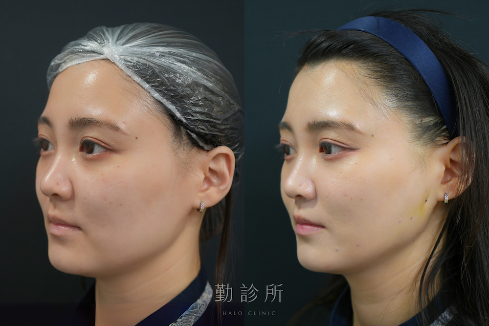 勤診所|跨層次迴繞拉提案例:中下臉拉提 抬升蘋果肌改善法令、V臉 左臉