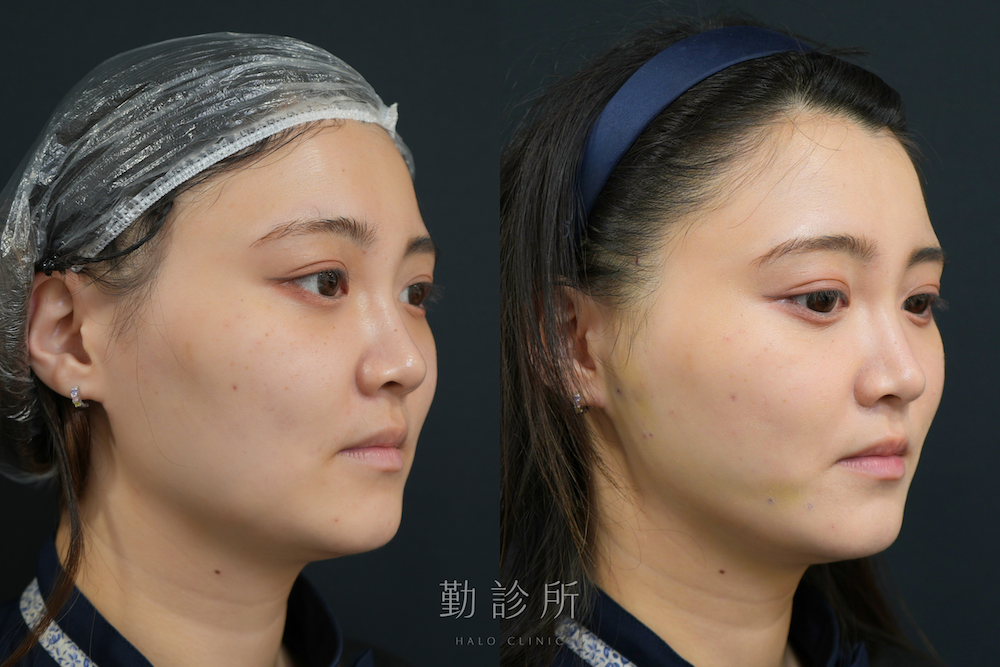 勤診所|跨層次迴繞拉提案例:中下臉拉提 抬升蘋果肌改善法令、V臉 右臉