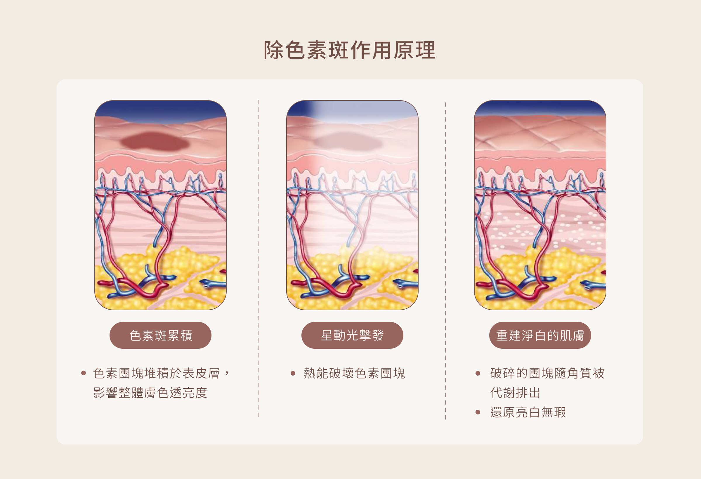 心動光 Stellar 除色素斑作用原理