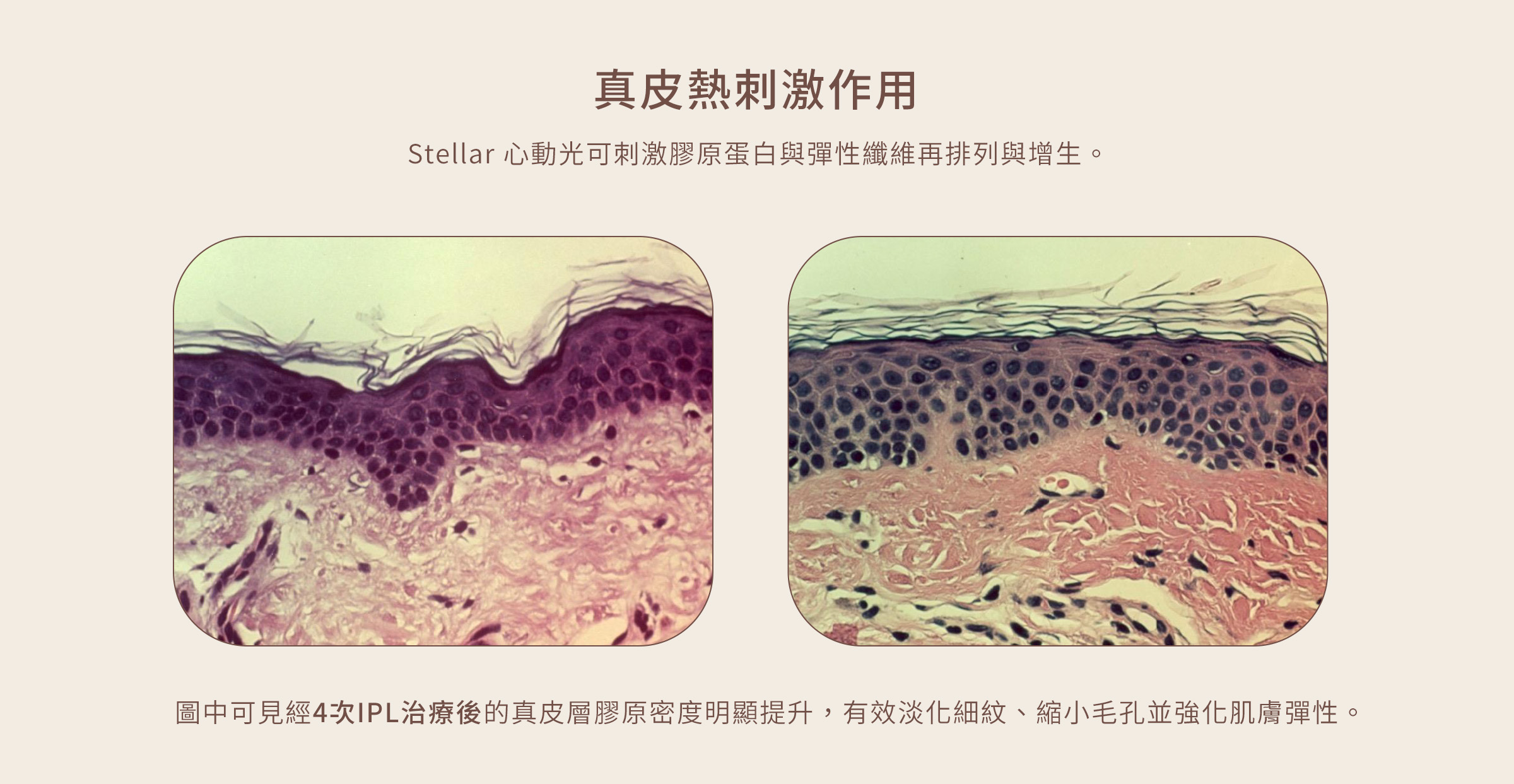 心動光 Stellar 真皮熱刺激作用