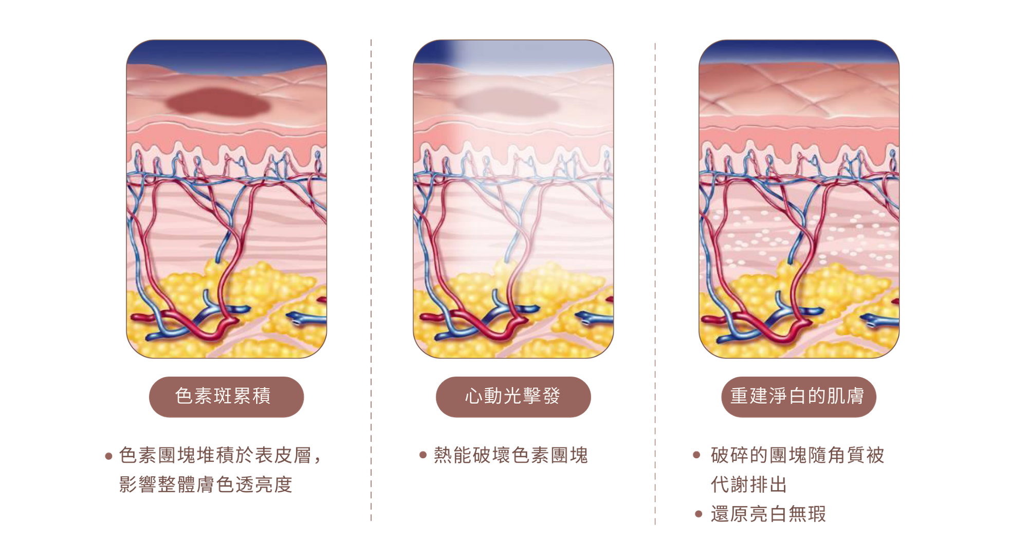 Stellar 心動光｜除色素斑作用原理