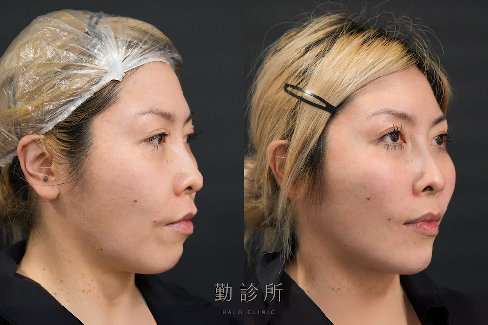 勤診所｜鳳凰電波案例：紫鑽探頭全臉＋緹奧希法令紋 右臉