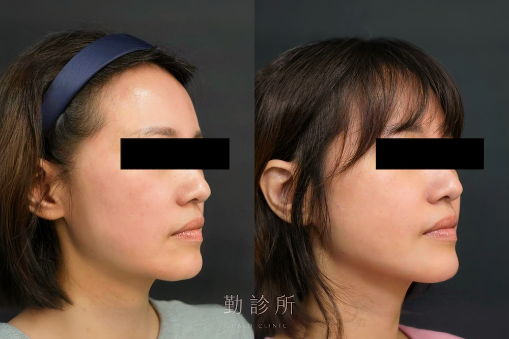 勤診所｜跨層次迴繞拉提案例：中下臉拉提改善嘴邊肉 右臉