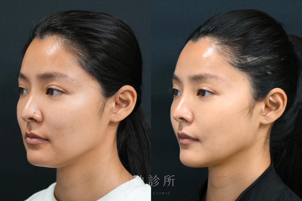 勤診所｜跨層次迴繞拉提案例：跨層次迴繞拉提下半臉 改善嘴邊肉、V臉 + 鳳凰電波紫鑽探頭全臉 左臉