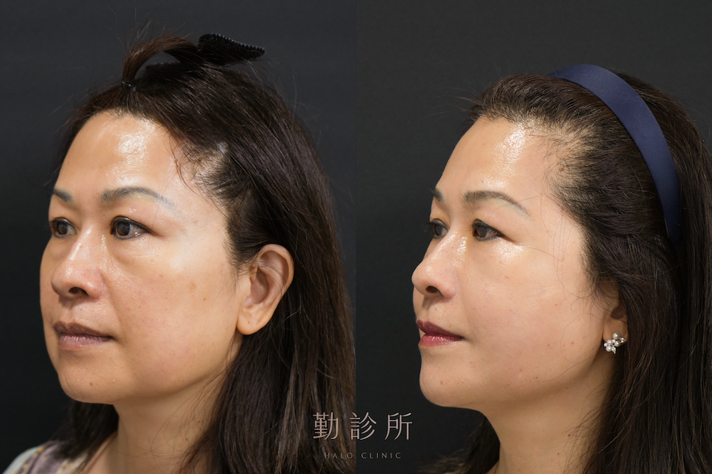 勤診所｜跨層次迴繞拉提案例：全臉組織抬升＋肉毒瘦小臉 左臉