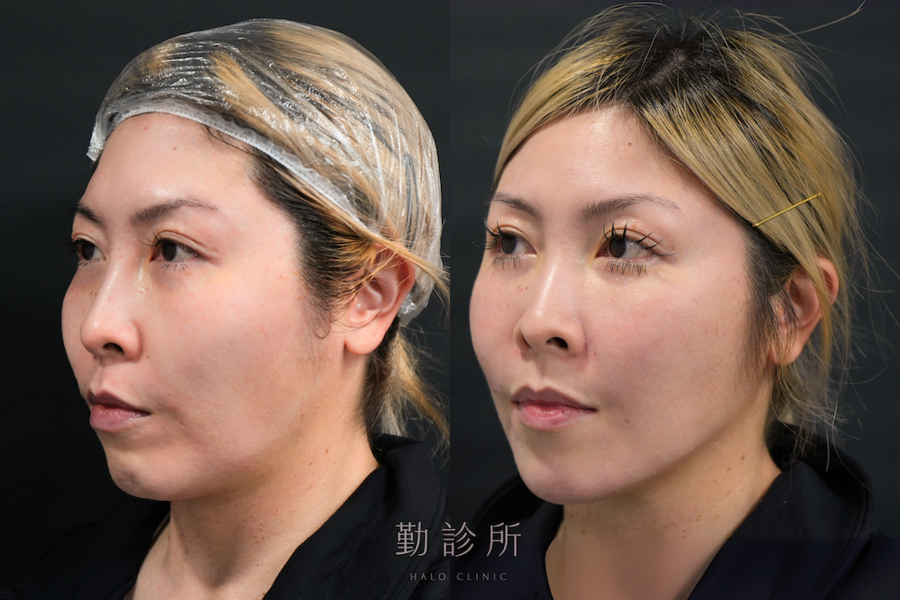 勤診所｜鳳凰電波案例：紫鑽探頭全臉＋緹奧希法令紋 左臉
