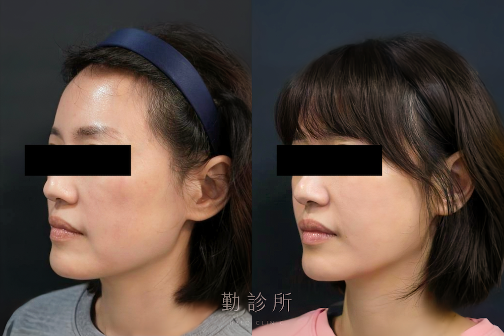 勤診所｜跨層次迴繞拉提案例：中下臉拉提改善嘴邊肉 左臉