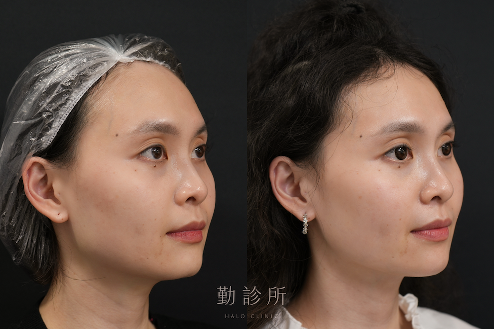 勤診所｜鳳凰電波案例：紫鑽探頭全臉 右臉