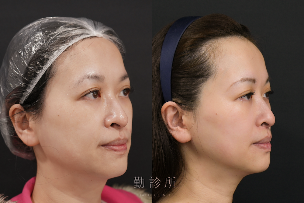 勤診所｜鳳凰電波案例：紫鑽探頭全臉 右臉