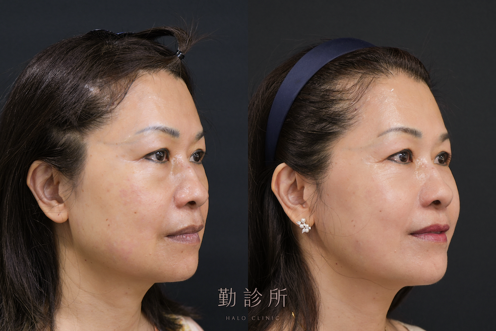 勤診所｜跨層次迴繞拉提案例：全臉組織抬升＋肉毒瘦小臉 右臉