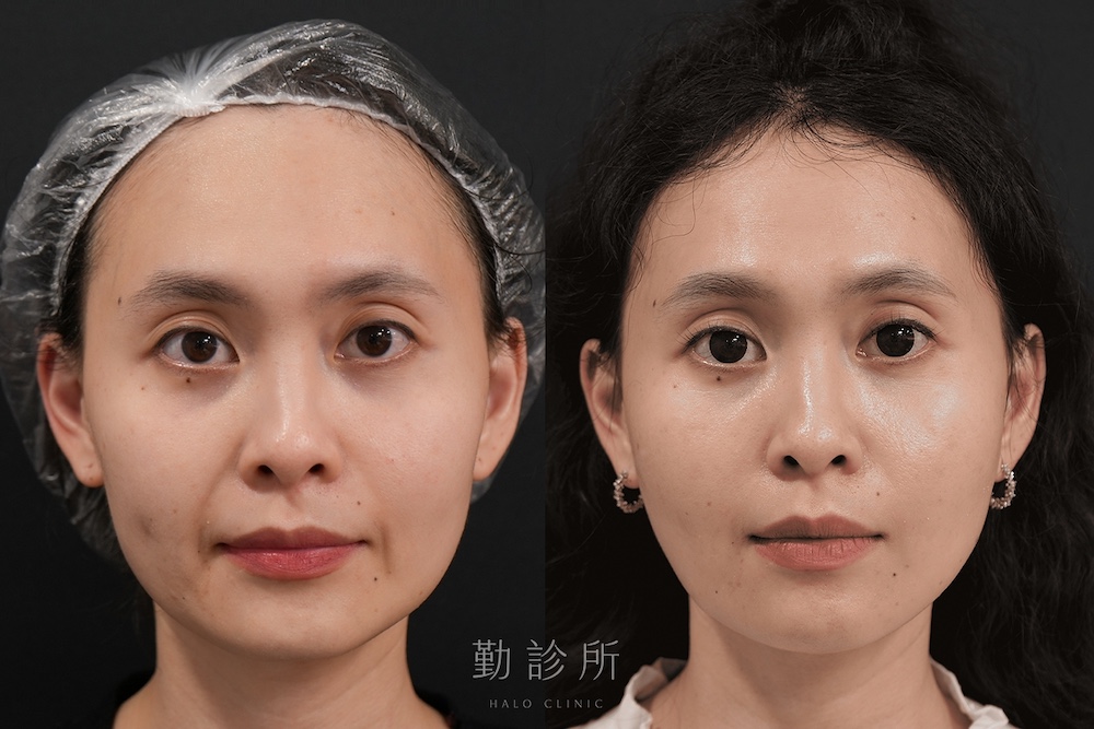 勤診所｜鳳凰電波案例：紫鑽探頭全臉 正面