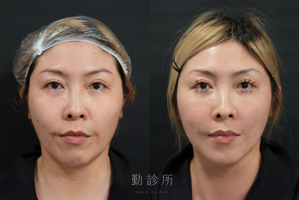 勤診所｜鳳凰電波案例：紫鑽探頭全臉＋緹奧希法令紋 正面