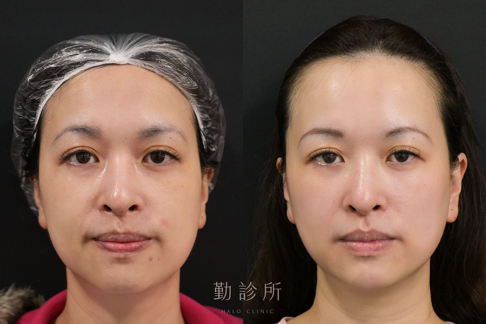 勤診所｜鳳凰電波案例：紫鑽探頭全臉 正面