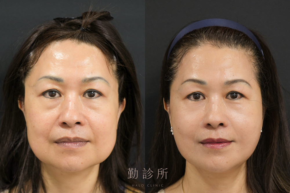 勤診所｜跨層次迴繞拉提案例：全臉組織抬升＋肉毒瘦小臉 正面