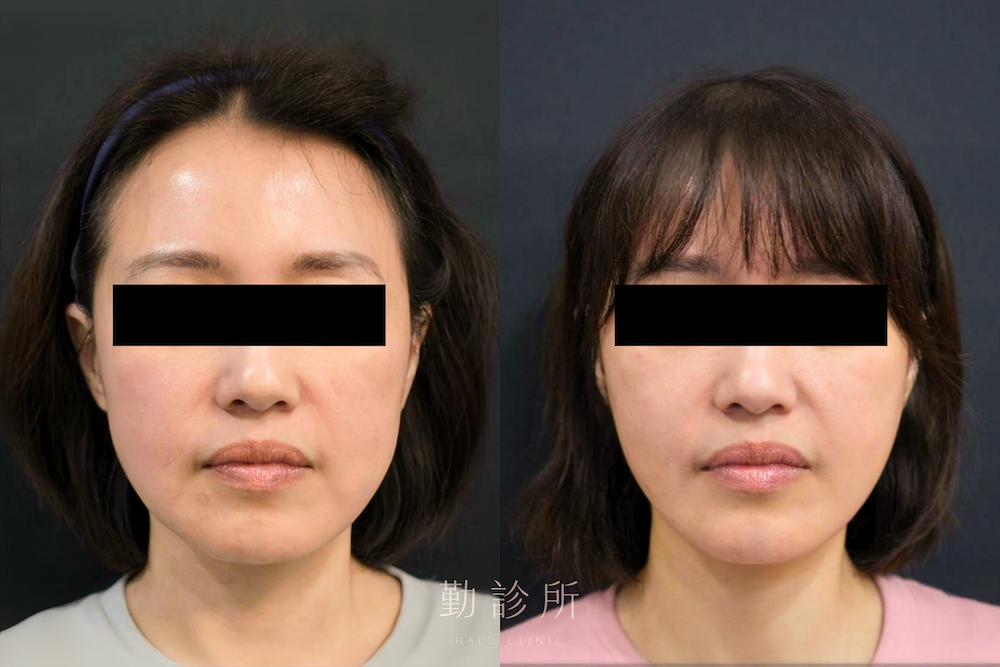 勤診所｜跨層次迴繞拉提案例：中下臉拉提改善嘴邊肉 正面
