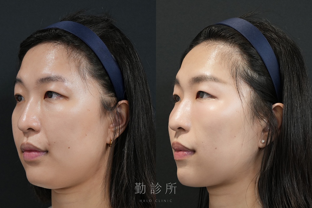 勤診所｜跨層次迴繞拉提案例：中下臉拉提 改善嘴邊肉、Ｖ臉 左臉