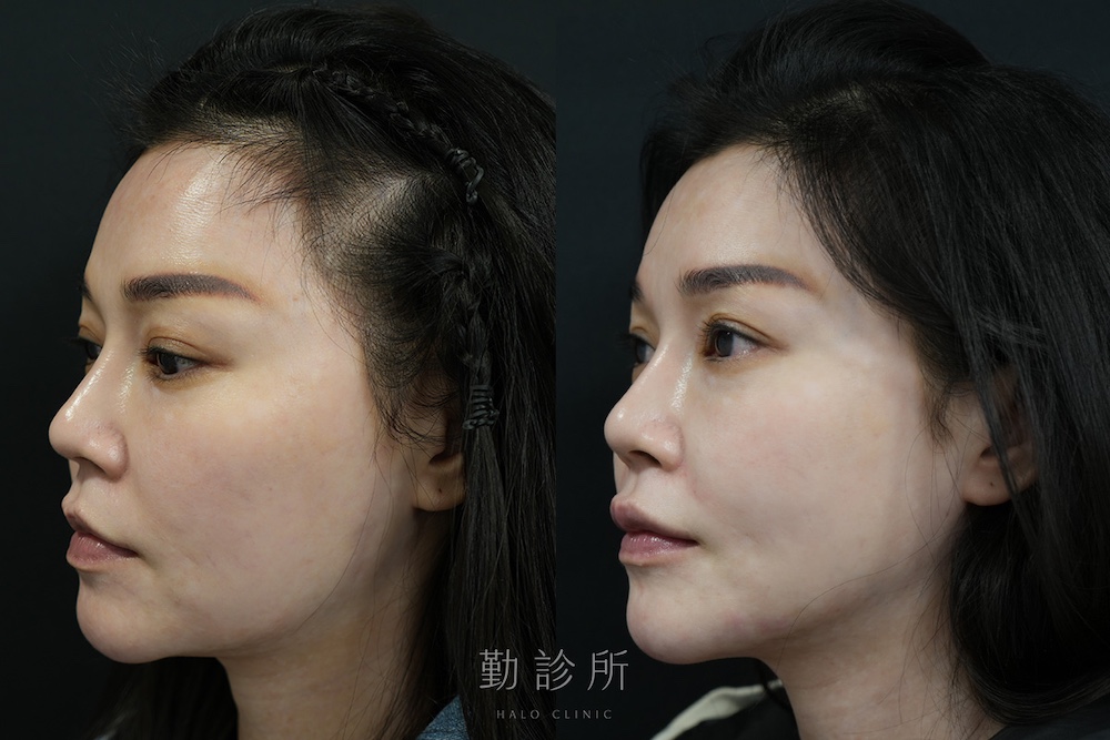 勤診所｜跨層次迴繞拉提案例：中下臉拉提 改善嘴邊肉、Ｖ臉 左臉