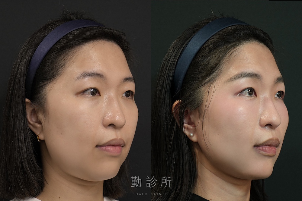 勤診所｜跨層次迴繞拉提案例：中下臉拉提 改善嘴邊肉、Ｖ臉 右臉