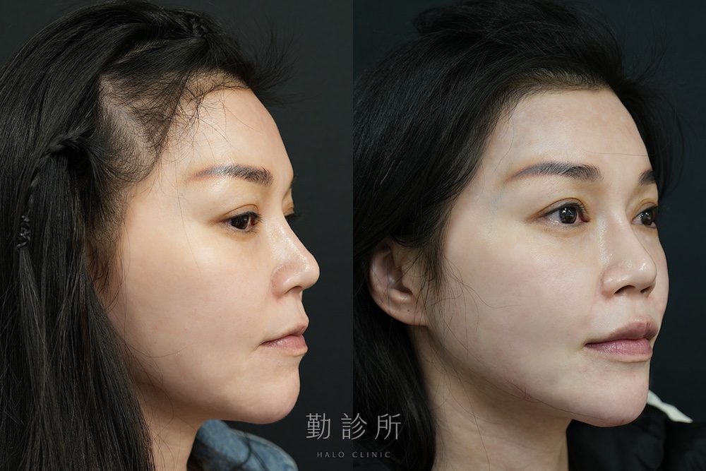勤診所｜跨層次迴繞拉提案例：中下臉拉提 改善嘴邊肉、Ｖ臉 右臉