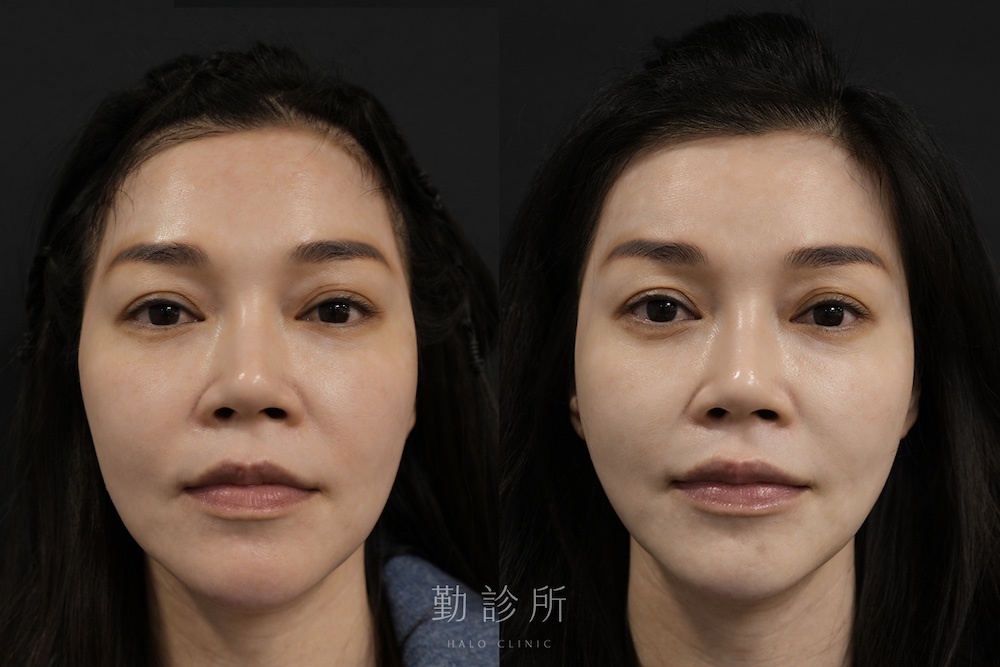 勤診所｜跨層次迴繞拉提案例：中下臉拉提 改善嘴邊肉、Ｖ臉 正面
