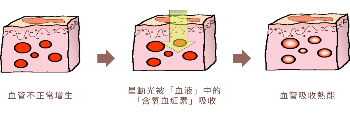 Stellar 心動光｜除血管病變作用原理