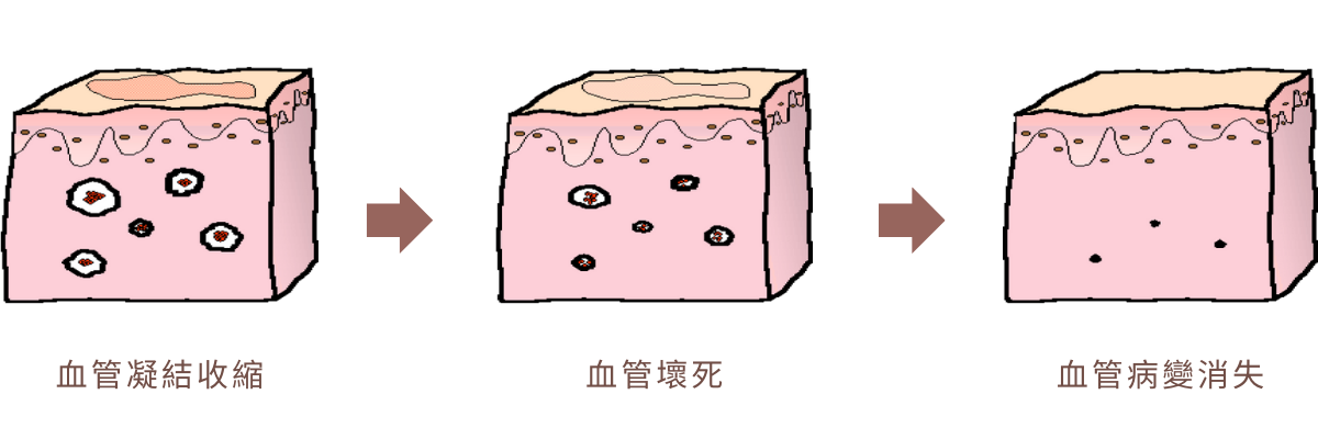 Stellar 心動光｜除血管病變作用原理