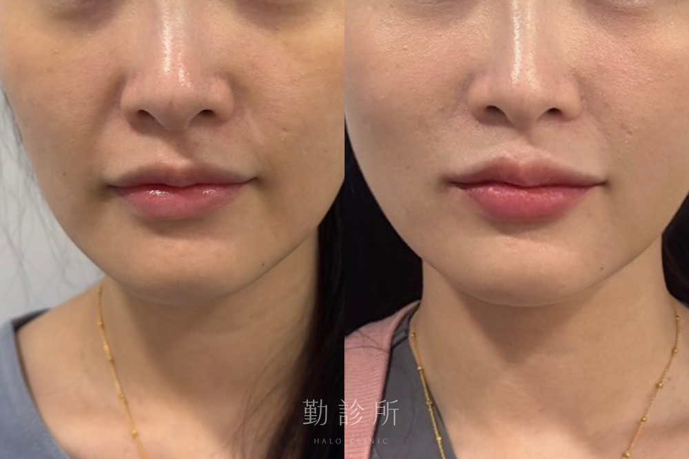 勤診所|玻尿酸豐唇案例: 正面