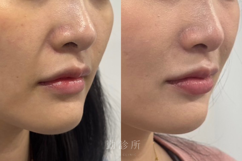 勤診所|玻尿酸豐唇案例: 右臉