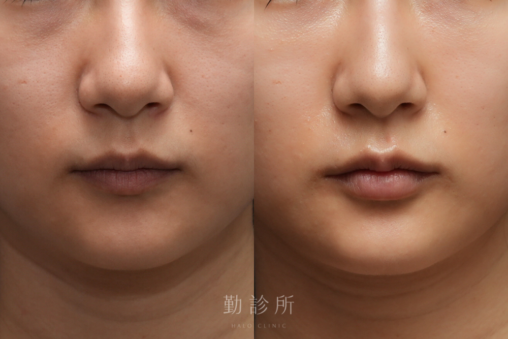 勤診所|玻尿酸豐唇案例:緹奧希動態隱形玻尿酸 正面