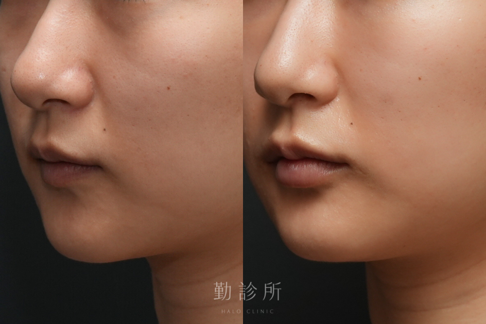 勤診所|玻尿酸豐唇案例:緹奧希動態隱形玻尿酸 左臉