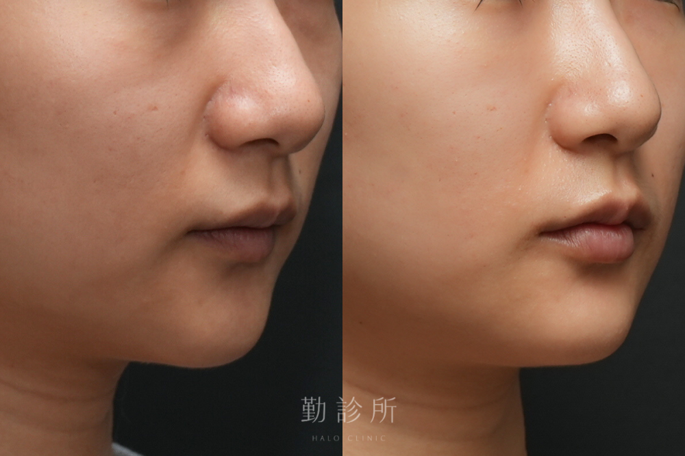 勤診所|玻尿酸豐唇案例:緹奧希動態隱形玻尿酸 右臉