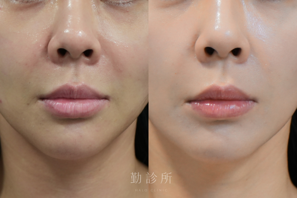 勤診所｜玻尿酸豐唇案例：緹奧希動態隱形玻尿酸 正面