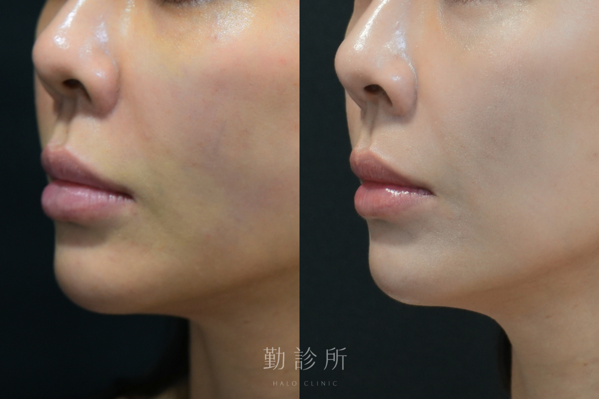 勤診所|玻尿酸豐唇案例:緹奧希動態隱形玻尿酸 左臉