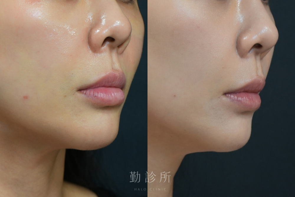 勤診所｜玻尿酸豐唇案例：緹奧希動態隱形玻尿酸 右臉