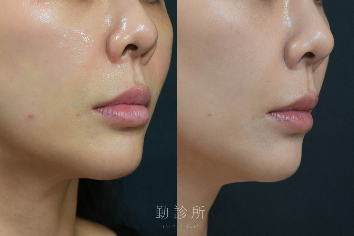 勤診所|玻尿酸豐唇案例:緹奧希動態隱形玻尿酸 右臉