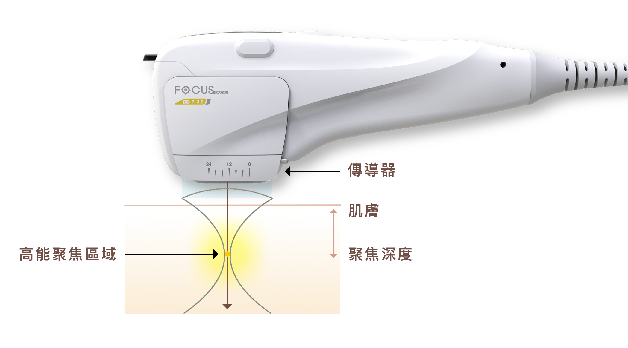 閃電音波也是使用同樣的原理，通過 4 MHz和 7 MHz的高能聚焦超音波將能量聚焦後，精準傳遞到治療部位的目標層次，以不傷害皮膚表面的方式加熱深部組織，使其產生60~70°C的熱能，進而達到收縮及拉提效果。