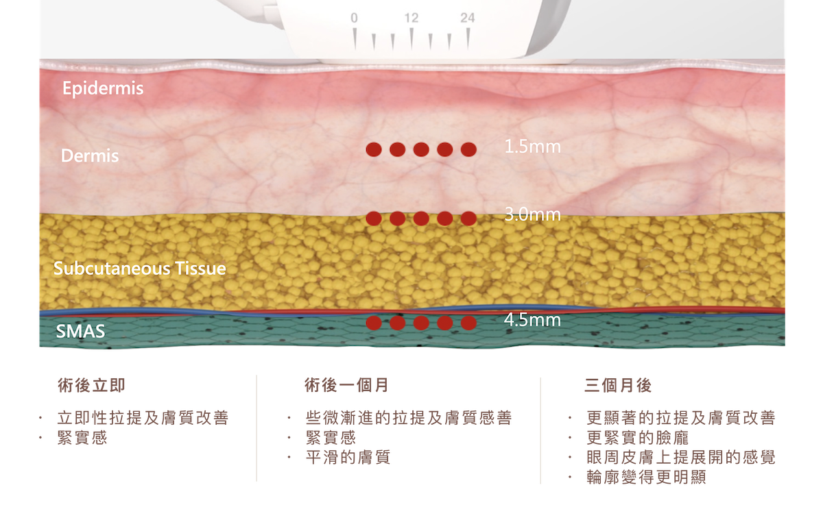 閃電音波配備三種不同深度的專用探頭，分別對應肌膚結構中的不同層次進行精準治療