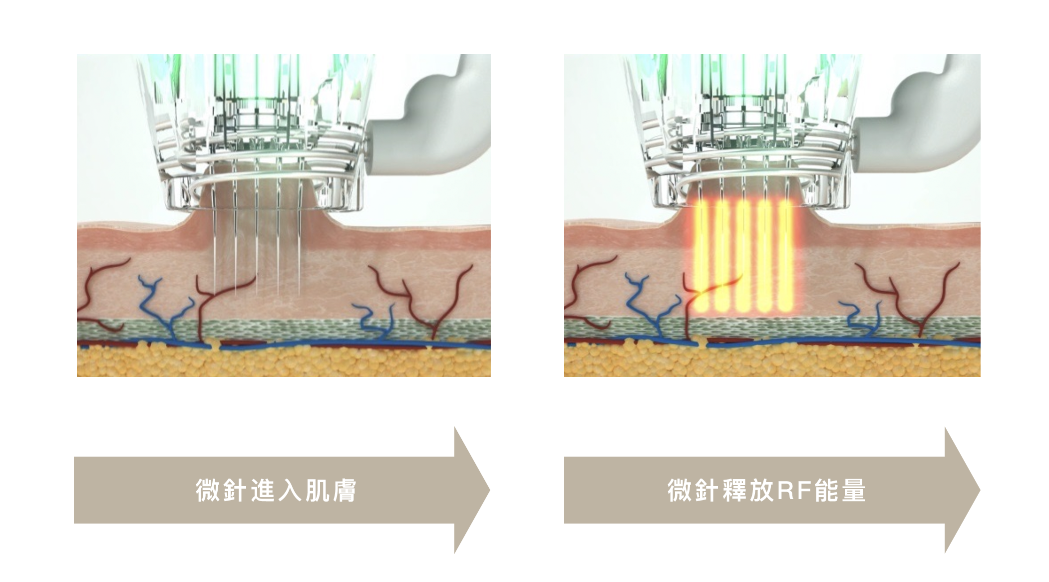 閃電微針|三大優點