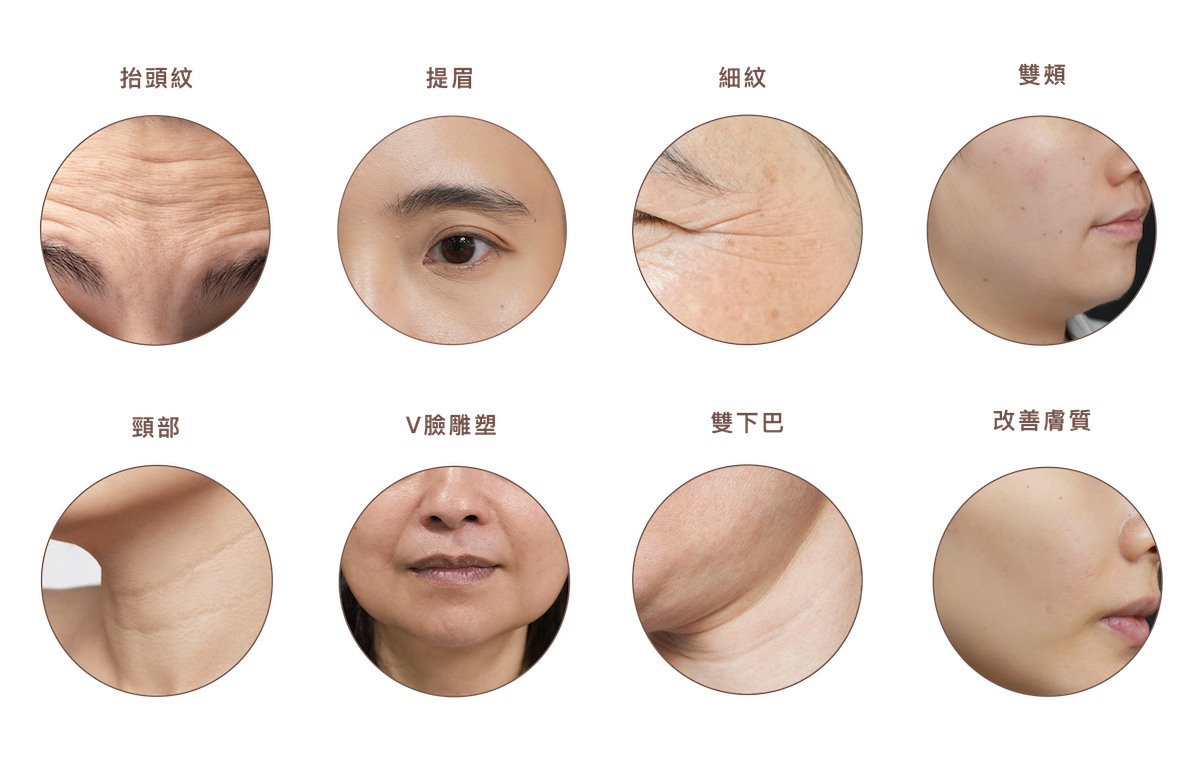 閃電音波療效全面且表現亮眼，無論是表層的抬頭紋、魚尾紋等靜態細紋，或是深層如蘋果肌下垂、下巴脂肪造成的輪廓鬆弛問題，都能逐一改善、精準對應。